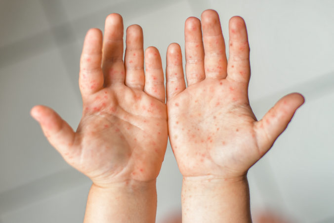 Hände mit Ausschlag der Hand-Fuß-Mund-Krankheit